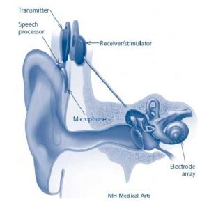 Cochlear_Implant-2